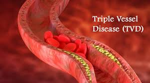 Triple Vessel Disease Treatment at Livasa Mohali - Advanced Cardiac Care